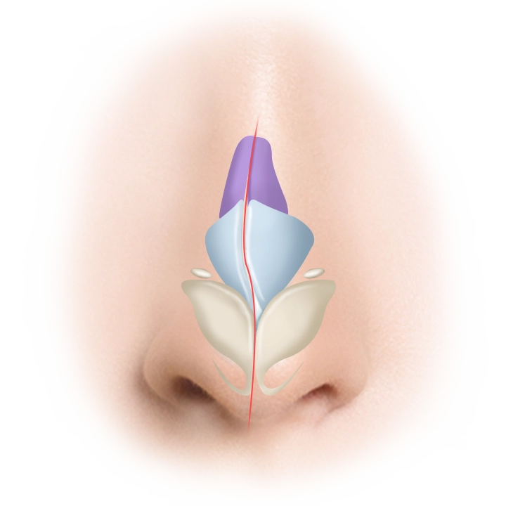 Хамрын үзүүрийг засах мэс заслын зураг, хамар өргөх мэс засал, гоо сайхны мэс засал.