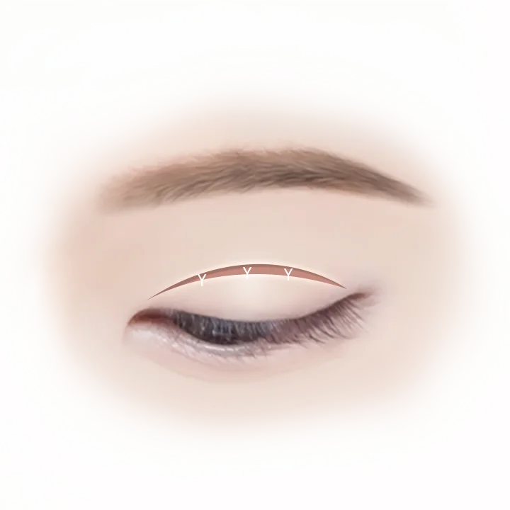 Зургийг хосгүй болгох зорилготойгоор дээд зовхины хосгүй оёдол тавих мэс заслын зураг.