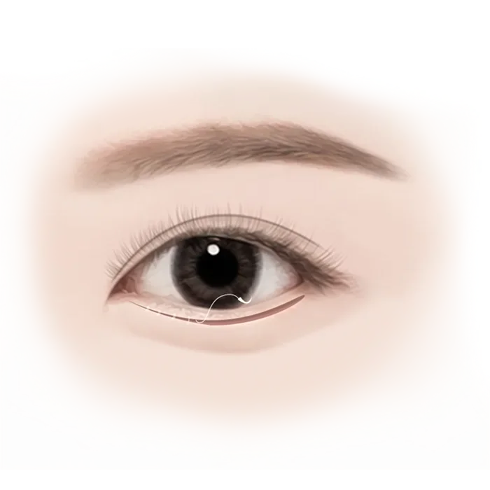 Зургийг харуулж байна: Дээд зовхины мэс засал хийлгэсэн эмэгтэй хүний нүдний хагалгааны зургийг харуулж байна.