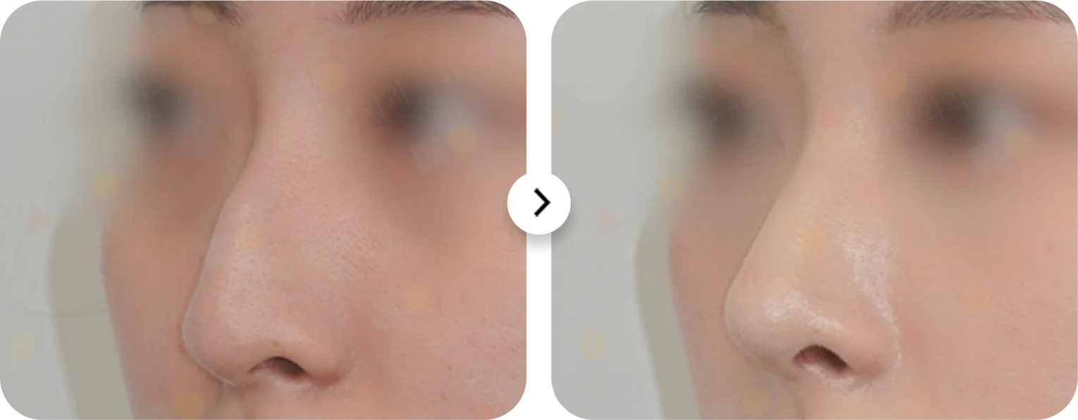 Энэ зурагт хамар засах мэс заслын үр дүнг харуулсан хамарны хажуугийн харьцуулсан зураг байна.