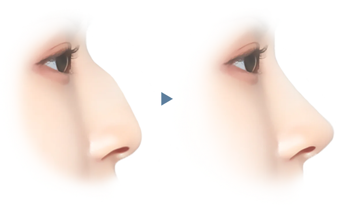 Энэхүү зурагт хамар өргөх мэс заслын үр дүнг харуулсан байна. Хамар өргөх мэс засал нь хамрын хэлбэрийг сайжруулж, царайны тэгш хэмийг тэнцвэржүүлдэг гоо сайхны мэс засал юм.