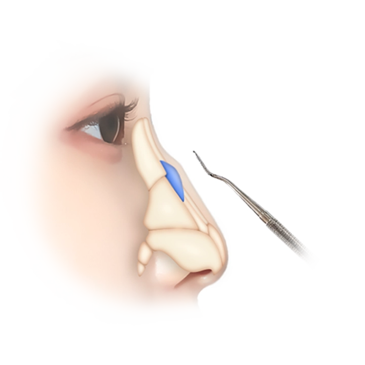 Хамрын мэс заслын хагалгааны дүрслэл, хамрын хэлбэр засах мэс заслын үе шатыг харуулсан зураг.