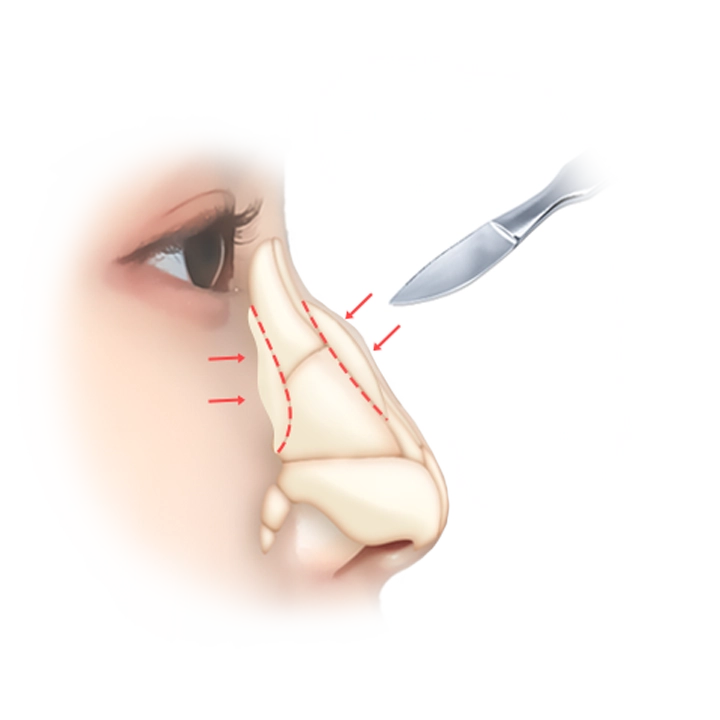 Хайч ба хамар зүсэх шугам бүхий хамарны мэс заслын график дүрслэл.