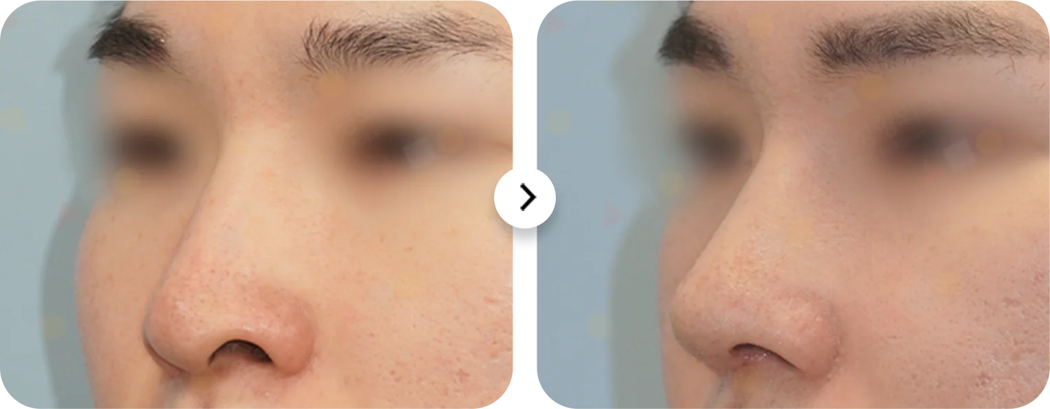 Энэ зурагт хамар өргөх мэс заслын хажуугийн харагдах байдлыг харуулсан бөгөөд хамарны хэлбэр, байрлал өөрчлөгдсөн нь харагдаж байна.