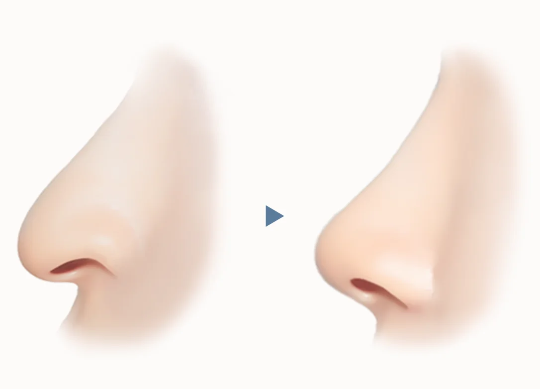 Хөндлөн огтлолын хамар зураг, хамар өргөх мэс заслын үр дүнг харуулсан хамарны хэлбэр өөрчлөгдсөн.