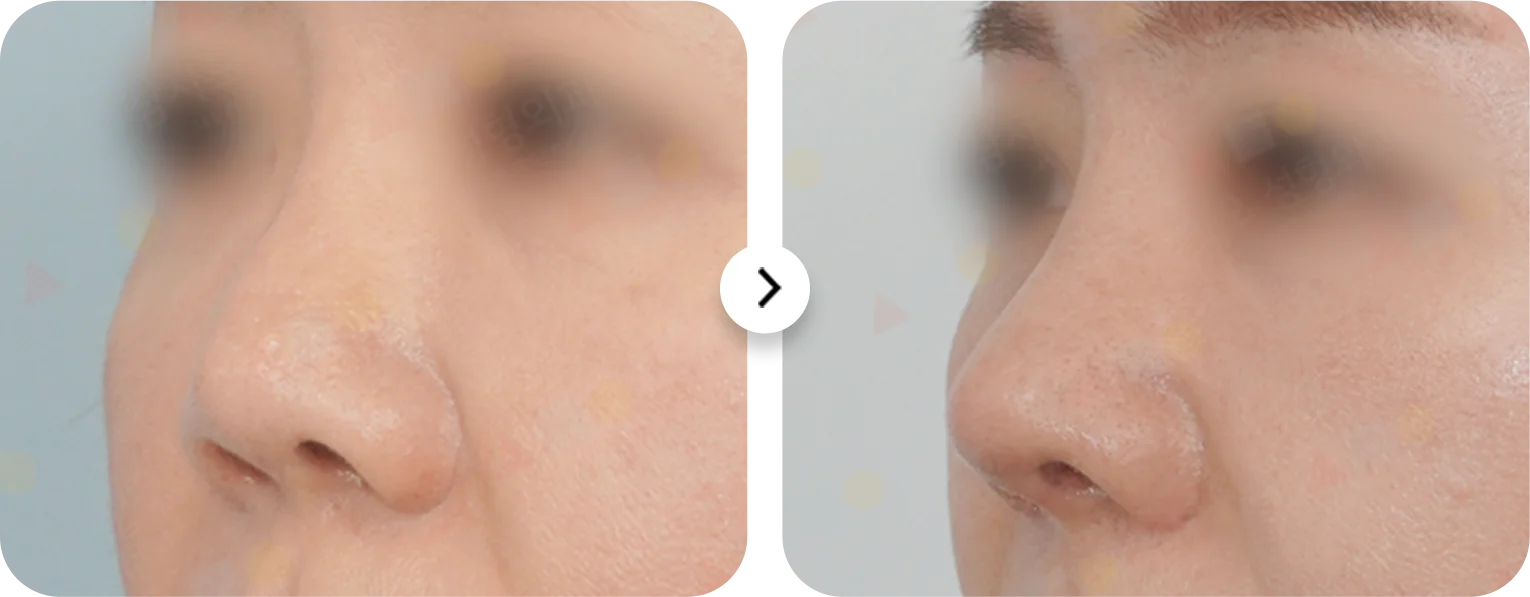 Энэ зурагт хамар засах мэс заслын үр дүнг харуулж байна. Хамрын үзүүрийг өргөж, хэлбэрийг нь сайжруулсан байна.