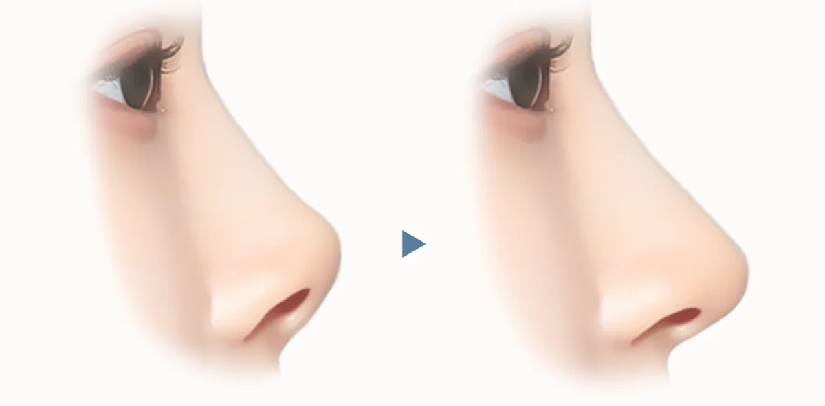 Энэхүү зурагт хамар өргөх мэс заслын үр дүнг харуулсан хажуугийн дүрслэл байна. Хамрын үзүүрийг өргөж, хамрын хэлбэрийг сайжруулсан харагдаж байна.