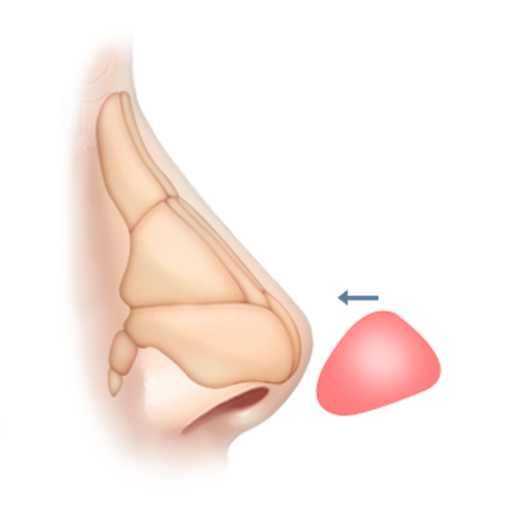 Хамрын мэс заслын зургийг харуулсан бөгөөд хамрын хэлбэрийг өөрчлөх мэс ажилбарыг дүрсэлсэн байна.