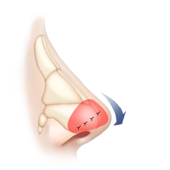 Хамрын үзүүрийг өргөх мэс заслын зурагт хамарны хэлбэрийг өөрчлөх мэс ажилбарыг дүрсэлжээ.