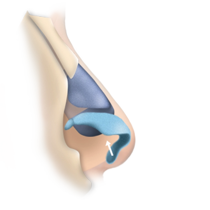 Хамрын үзүүрийг өргөх мэс заслын график дүрслэл, хамрын хэлбэр засах мэс засал, гоо сайхны мэс засал.