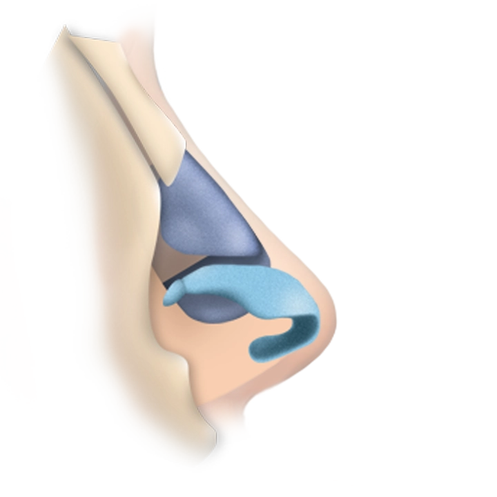 Хамрын хөндийн хамар битүүрэх, хамар дайвар хөндийн үрэвсэл болон хамар залгиурын хорт хавдрын үед мэс заслын аргаар эмчлэх боломжтой.