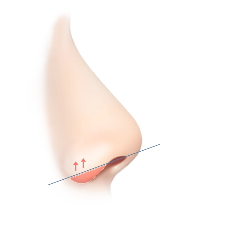 Хамрын үзүүрийг өргөх мэс заслын зураг. Хамрын үзүүрийг өргөх мэс заслын үйл явцыг дүрсэлсэн зураг.