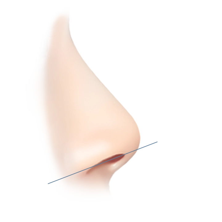 Хамрын үзүүрийг өргөх мэс заслын зураг. Хамрын үзүүрийг өргөх мэс засал нь хамрын үзүүрийг илүү тодорхой болгоход тусалдаг гоо сайхны мэс засал юм.