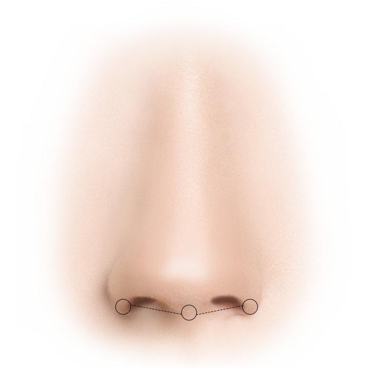 Уруулын өргөлтийн мэс заслын зургийг харуулсан бөгөөд хагалгааны зүсэлтийг харуулсан байна.