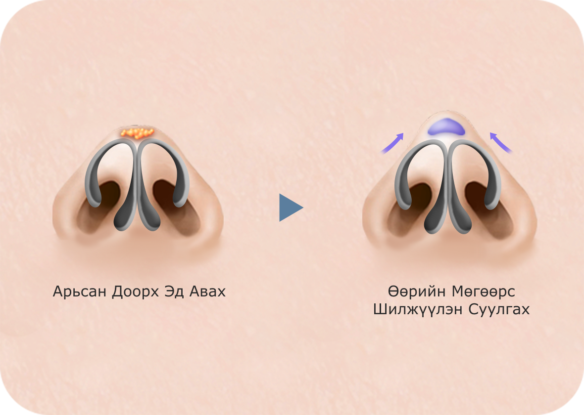 Хамрын үзүүрийг өөрийн мөгөөрсөөр засах мэс заслын зураг. Хамрын үзүүрийг өргөх, хэлбэржүүлэхэд өөрийн мөгөөрс шилжүүлэн суулгах мэс засал хийгддэг.