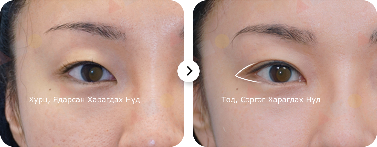 Нүдний мэс заслын зургийг харуулсан байна. Зүүн талд нь хурц, ядарсан харагдах нүд, баруун талд нь тод, сэргэг харагдах нүдтэй харьцуулсан байна.
