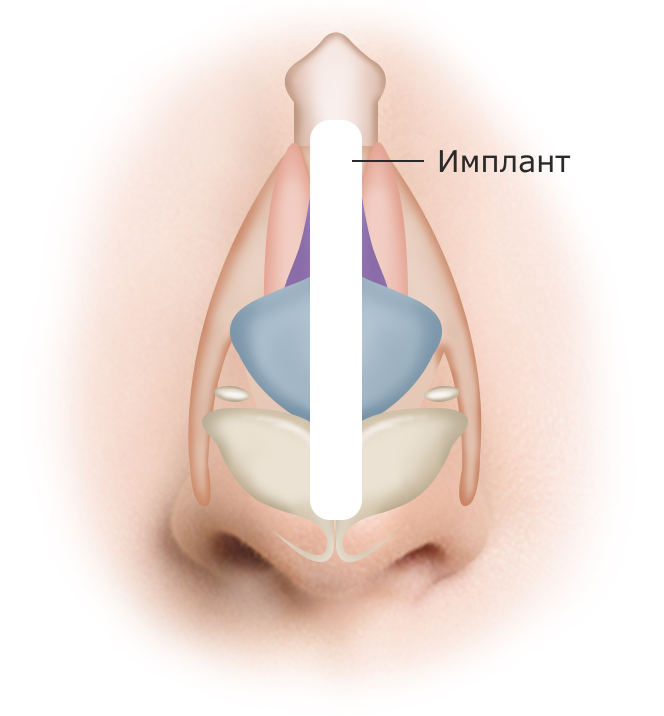 Хамрын гол хэсэгт суулгац суулгах мэс заслын зураг. Хамрын мэс засал нь хамрын хэлбэрийг засаж, амьсгалыг сайжруулдаг.