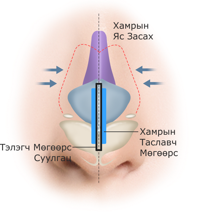 Хамрын гол хагалгааны зурагт хамрын ясыг засах, хамрын таславч мөгөөрс, тэлэгч мөгөөрс суулгац зэргийг дүрсэлжээ.