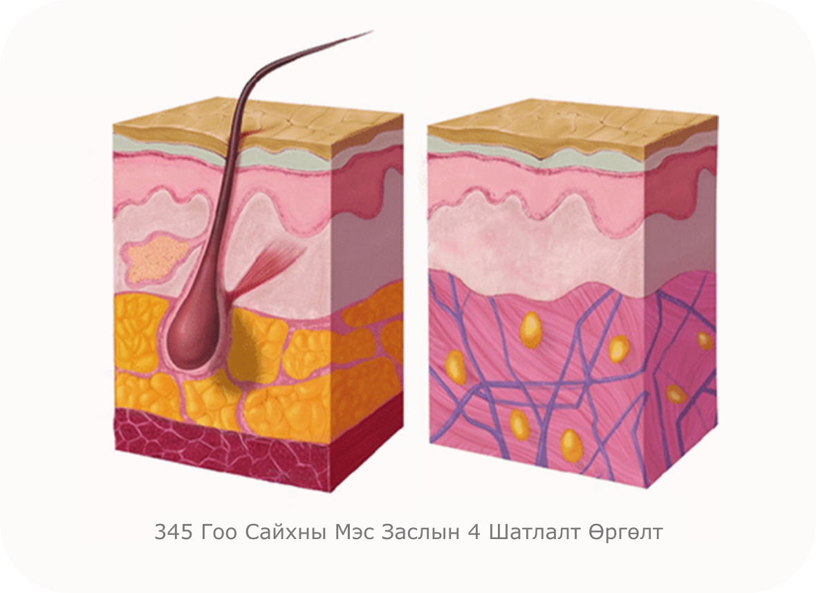 Нүүр өргөх мэс заслын арьсны бүтцийг харуулсан зураг. Арьсны давхаргууд, үсний уутанцар, өөхөн эд, коллагены утас зэргийг дүрсэлсэн байна.