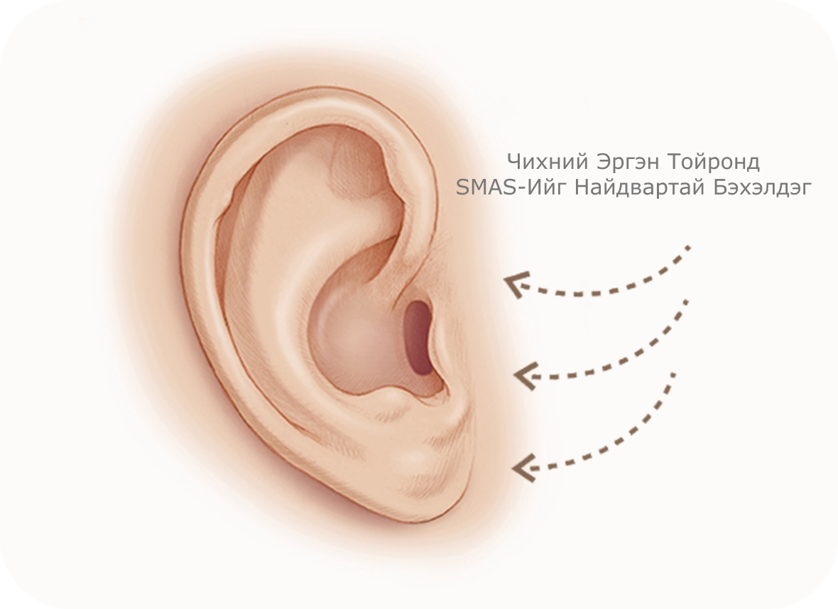 Чихний эргэн тойронд SMAS-ийг найдвартай бэхэлдэг нүүр өргөх мэс заслын зураг.