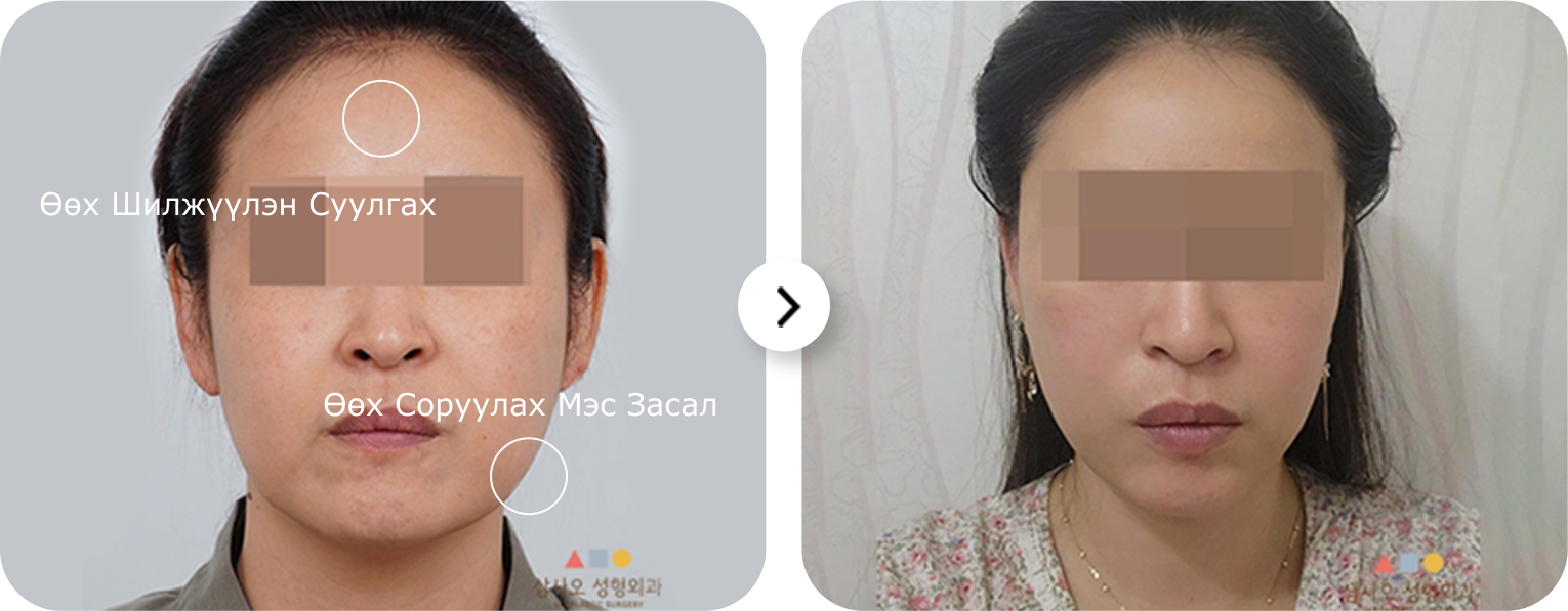 Эмэгтэй хүний нүүрний өөх шилжүүлэн суулгах болон өөх соруулах мэс заслын зураг.