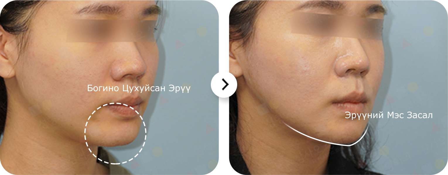 Эрүүний шугам лифтинг мэс заслын үр дүн, эрүүний хэлбэрийг сайжруулсан, нүүрний контурыг тодотгосон.