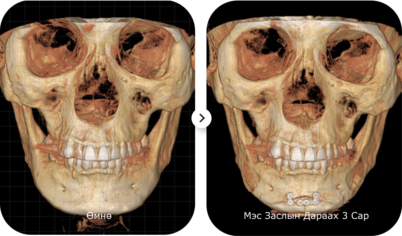 Энэ бол эрүүний имплант суулгах мэс заслын үр дүнгийн харьцуулсан рентген зураг бөгөөд эрүүний хэлбэрийг өөрчилж, нүүрний контурыг сайжруулсан байна.