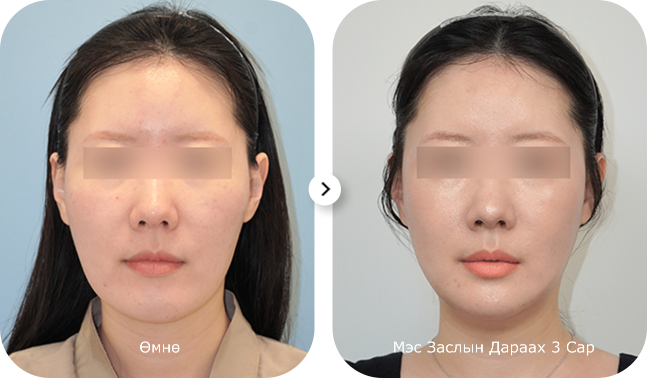 Эмэгтэй хүний нүүрний зураг, эрүүний шугам лифтинг мэс заслын дараах өөрчлөлт харагдаж байна.