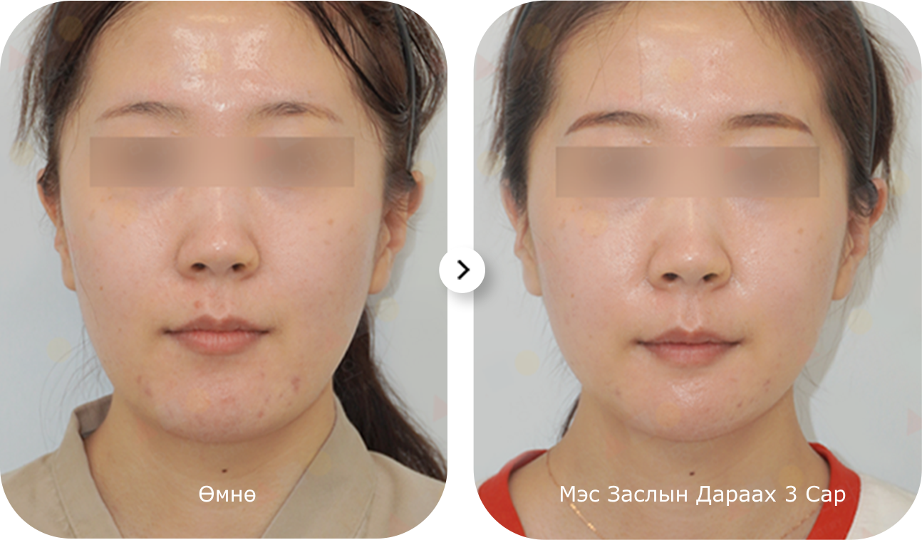 Эмэгтэй хүний нүүрний зураг, эрүүний шугам лифтинг мэс заслын үр дүн харагдаж байна.