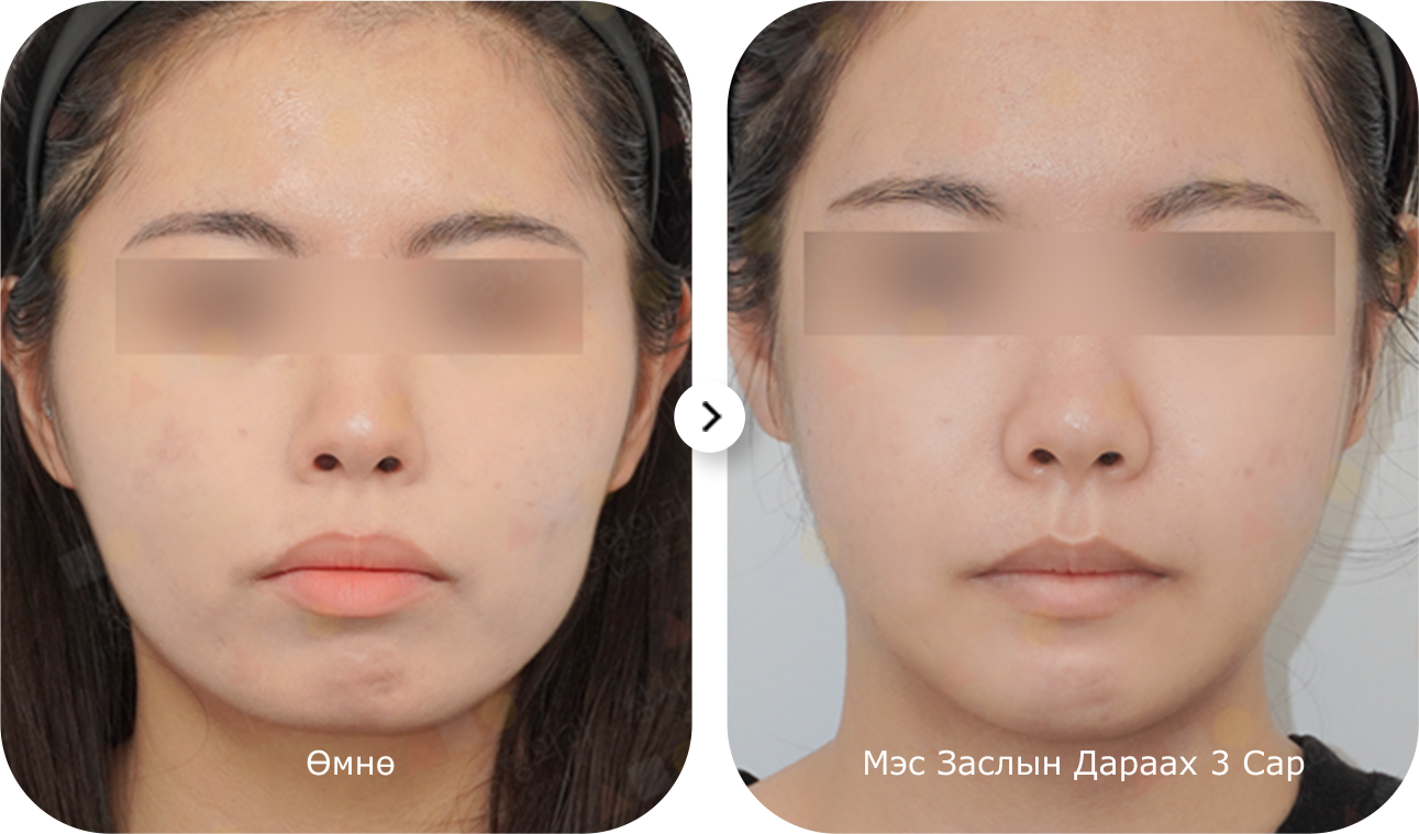 Эрүүний шугам лифтинг мэс заслын үр дүн, нүүрний контур сайжирч, арьс чангарсан харагдаж байна.