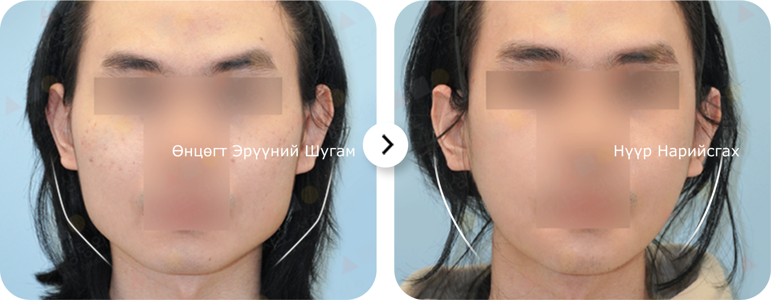 Эрүүний шугам лифтинг мэс заслын нөлөөгөөр нүүрний өнцөг хэлбэржиж, нүүр нарийссан хүний дүрсийг харуулсан зураг.