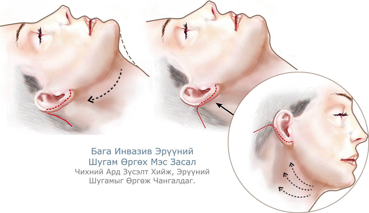 Энэ зурагт эрүүний шугам лифтинг мэс заслын зургийг харуулсан бөгөөд мэс ажилбарын дарааллыг харуулсан зураг байна.