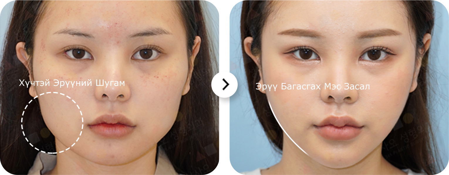 Эрүүний шугам лифтинг мэс заслын үр дүн: Ази эмэгтэйн царайны эрүүний хэлбэрийг өөрчилсөн, нүүрний контур засч, эрүүг багасгасан байна.