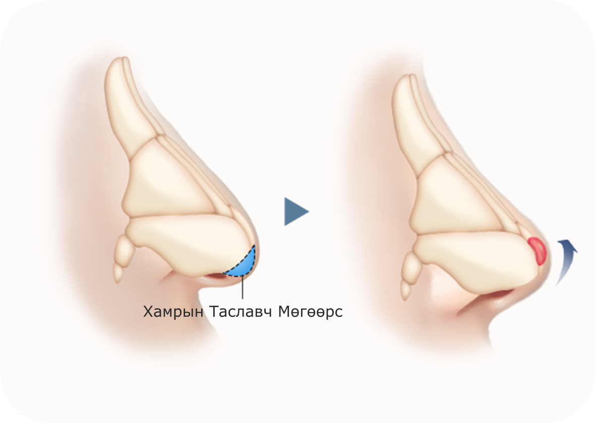 Хамар заслын мэс ажилбарын хамарны таславч мөгөөрсний хэлбэрийг өөрчлөх эмчилгээний зураг.