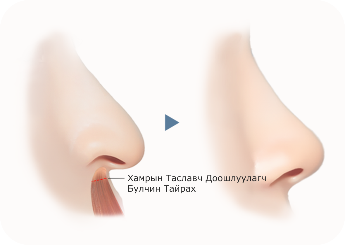 Хамрын үзүүр өргөх мэс заслын зурагт хамрын булчинг тайрах замаар хамрын үзүүрийг өргөх үйл явцыг харуулсан байна.