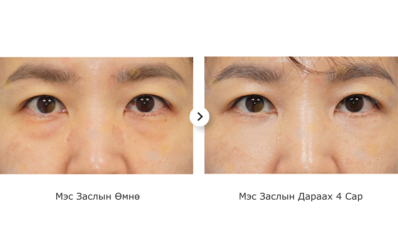 Зургийг харахад нүдний доод уутны мэс заслын ажилбарыг хийлгэсний дараах өөрчлөлт харагдаж байна.