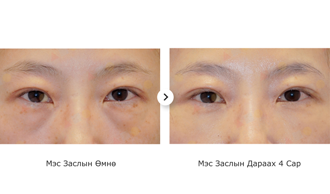 Зургийг нүдний доод уутны мэс заслын үр дүнг харуулахад ашигласан. Нүдний доод уутны мэс засал нь нүдний доорх уутыг арилгах гоо сайхны мэс засал юм.