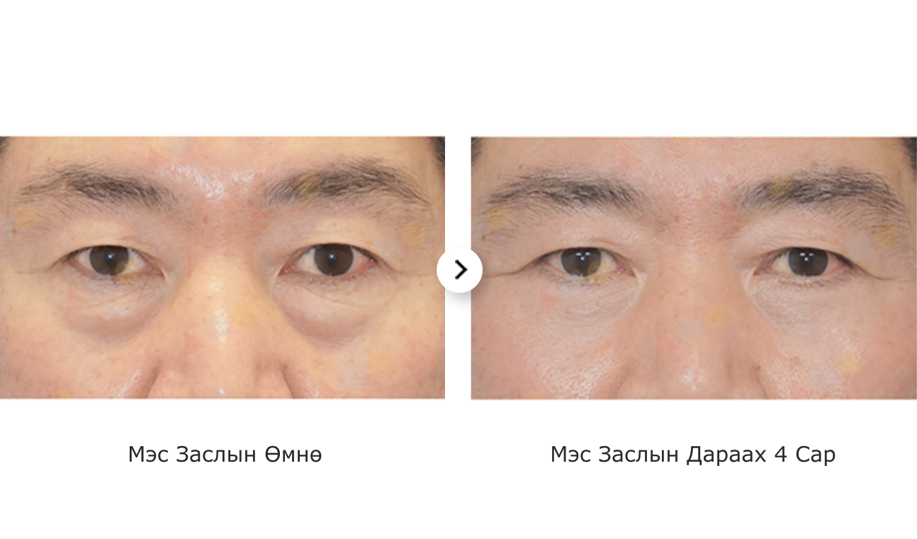 Зургийг нүдний доод уутны мэс заслын үр дүнг харуулахаар хажуу тийш нь харьцуулсан байна.