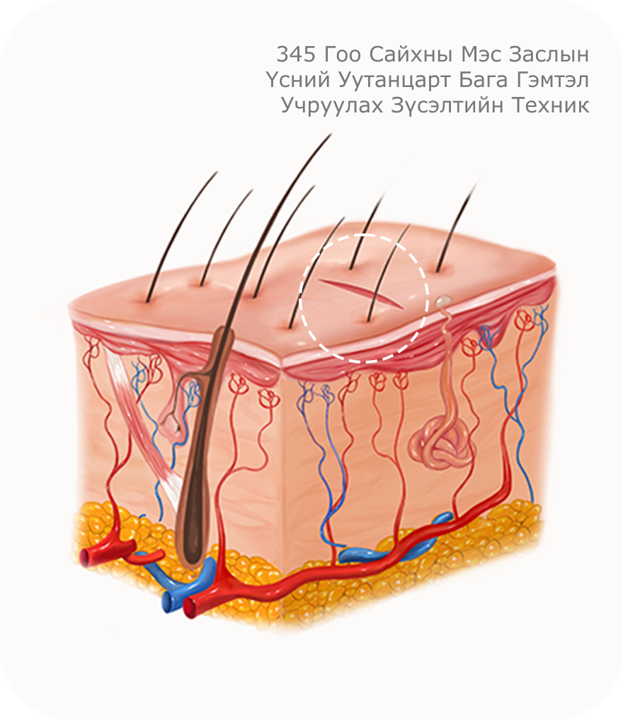 Бага зүслэгтэй лифтинг мэс заслын үед үсний уутанцарт бага гэмтэл учруулах зүсэлтийн техник болохыг харуулсан зураг.