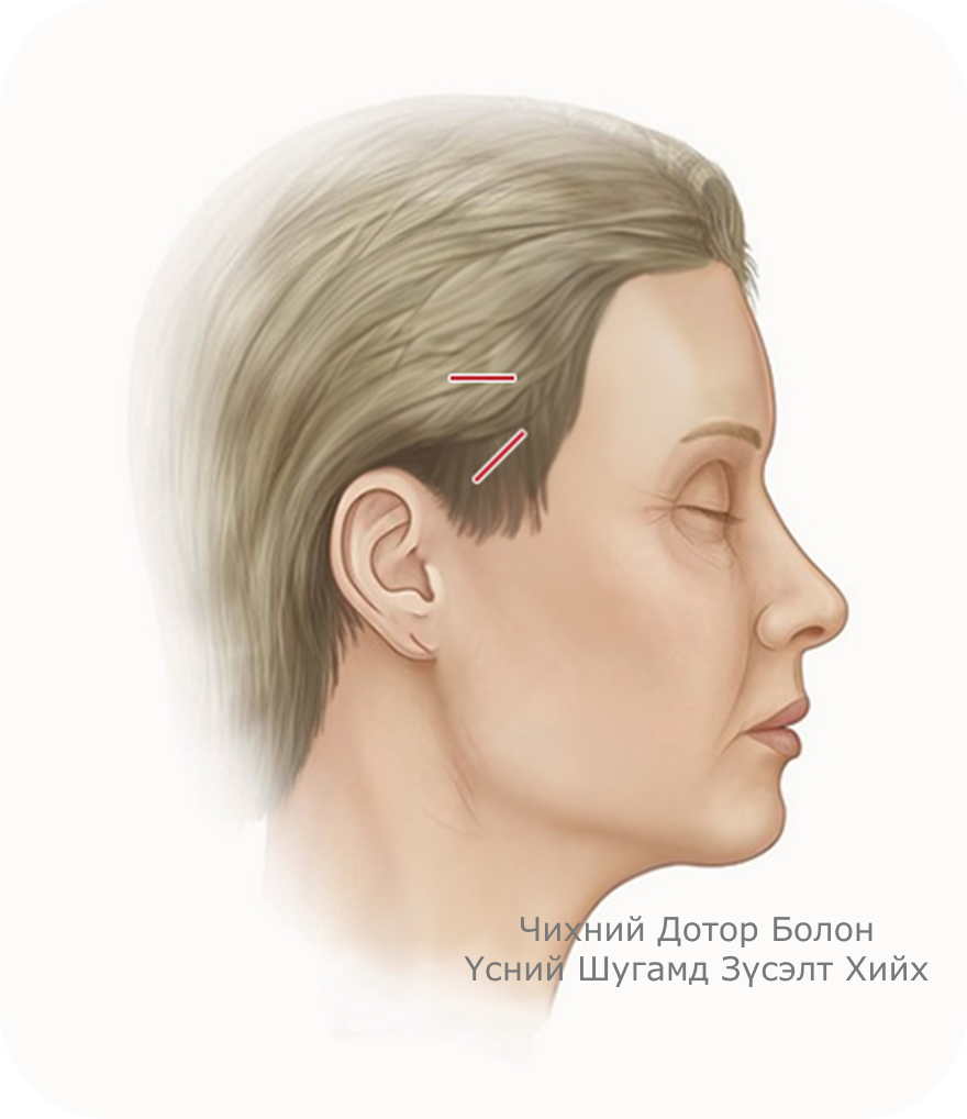 Чихний дотор болон үсний шугамд зүсэлт хийх байрлалыг харуулсан зураг, нүүр өргөх мэс заслын үеийн зүсэлтийн байрлал.