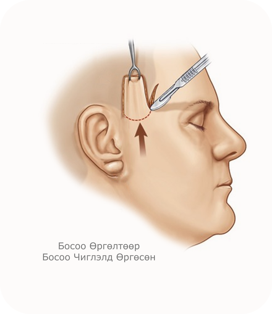 Босоо өргөлтөөр босоо чиглэлд өргөсөн нүүрний контур, лифтингийн мэс заслын зургийг үзүүлсэн зураг.