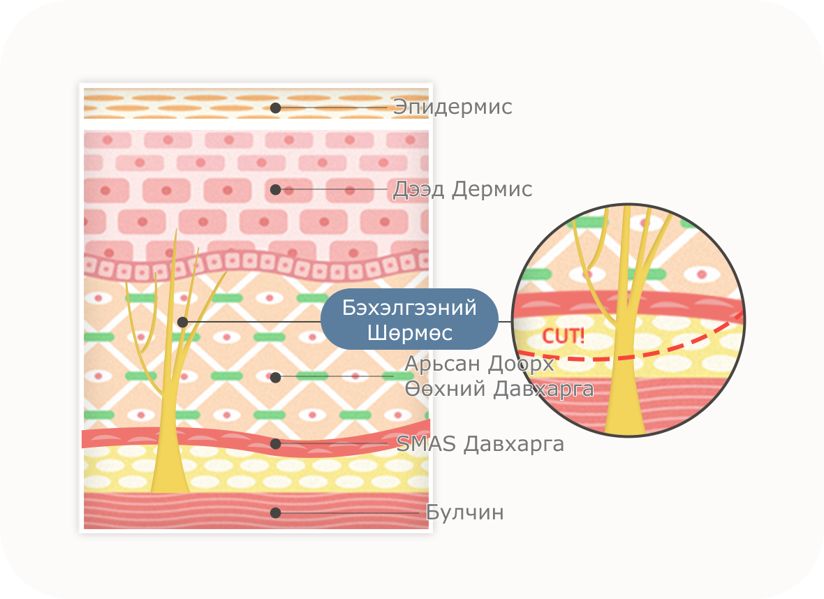 Нүүр өргөх мэс заслын арьсны бүтэц, давхаргыг харуулсан зураг. Эпидермис, дээд дермис, бэхэлгээний шөрмөс, арьсан доорх өөхний давхарга, SMAS давхарга, булчин байна.