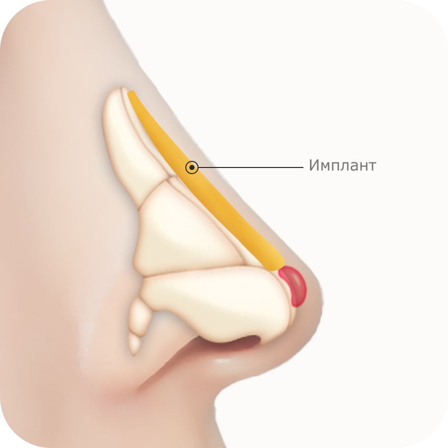Хамрын мэс заслын зургийн дүрслэл дээр хамрын хэлбэрийг сайжруулах зорилгоор хамар имплант суулгахыг харуулсан байна.