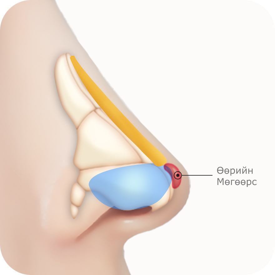 Хамрын үзүүрийн мөгөөрс, хамар, арьсыг хажуу талаас нь харуулсан хамар өргөх мэс заслын зураг.