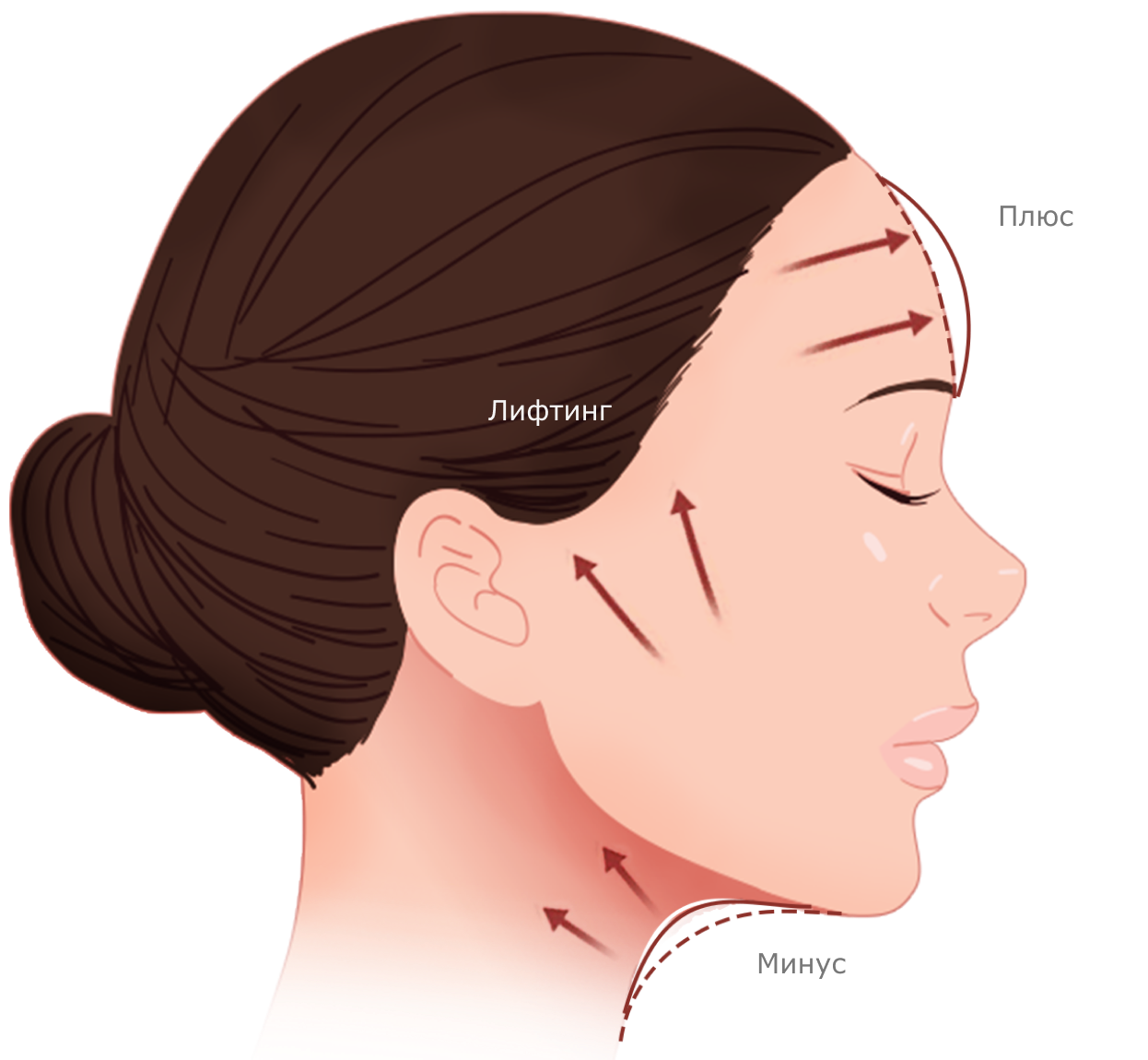 Нүүрний арьсыг өргөх мэс заслын зурагт дух, хацар, хүзүүний арьсыг чангалах чиглэлийг сумтайгаар дүрсэлжээ.