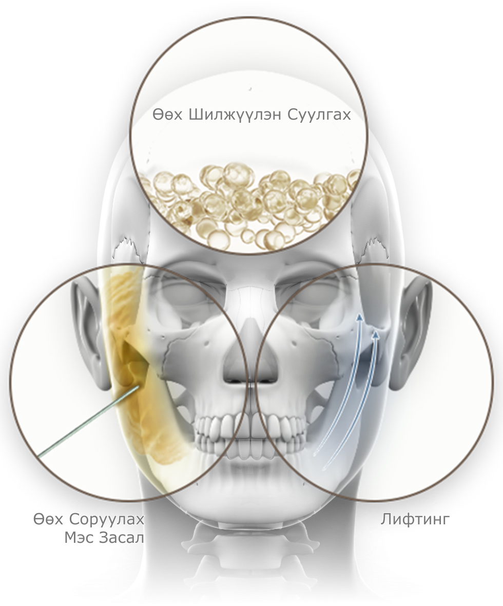 Нүүрний араг ясны зурагт нүүр өргөх мэс засал, өөх шилжүүлэн суулгах болон өөх соруулах мэс заслыг дүрсэлсэн байна.