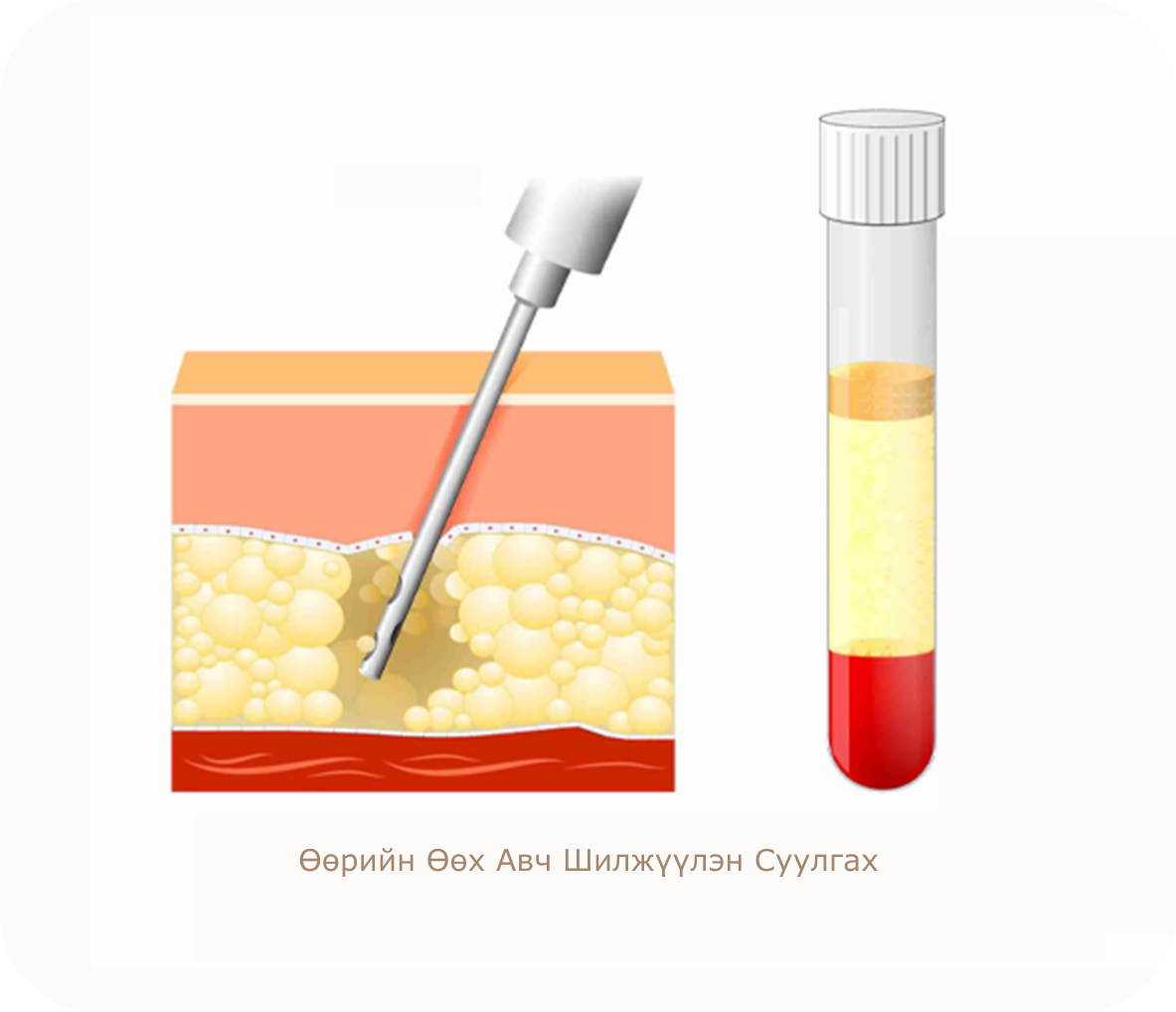 Өөрийн өөх авч шилжүүлэн суулгах мэс заслын зураг. Арьсан доор өөх шилжүүлэн суулгах болон цусны сийвэнгийн ялгаралтыг харуулсан зураг.
