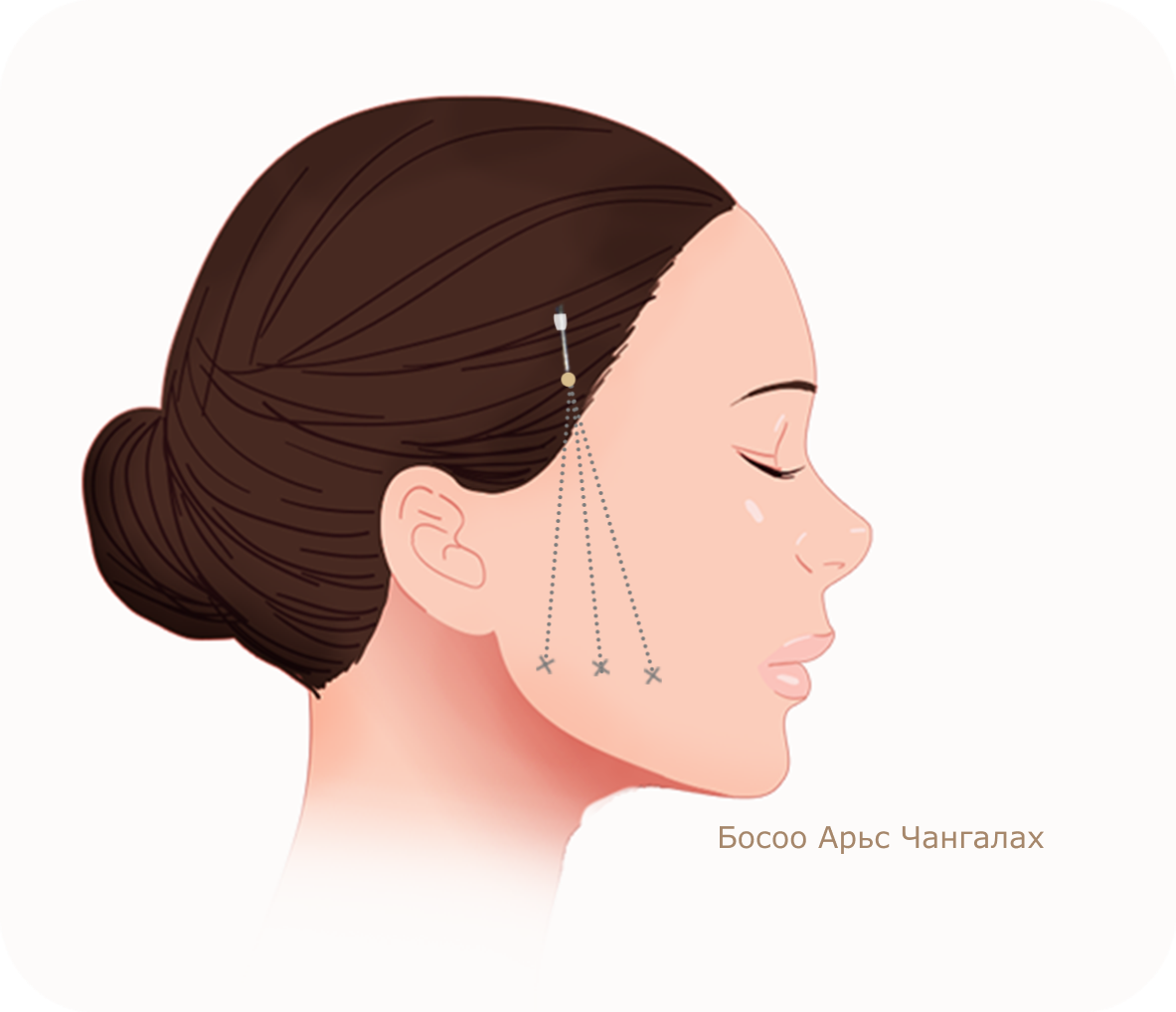 Эмэгтэй хүний нүүрний хажуугийн зураг, утас ашиглан арьс чангалах босоо лифтинг мэс заслын дүрслэл.