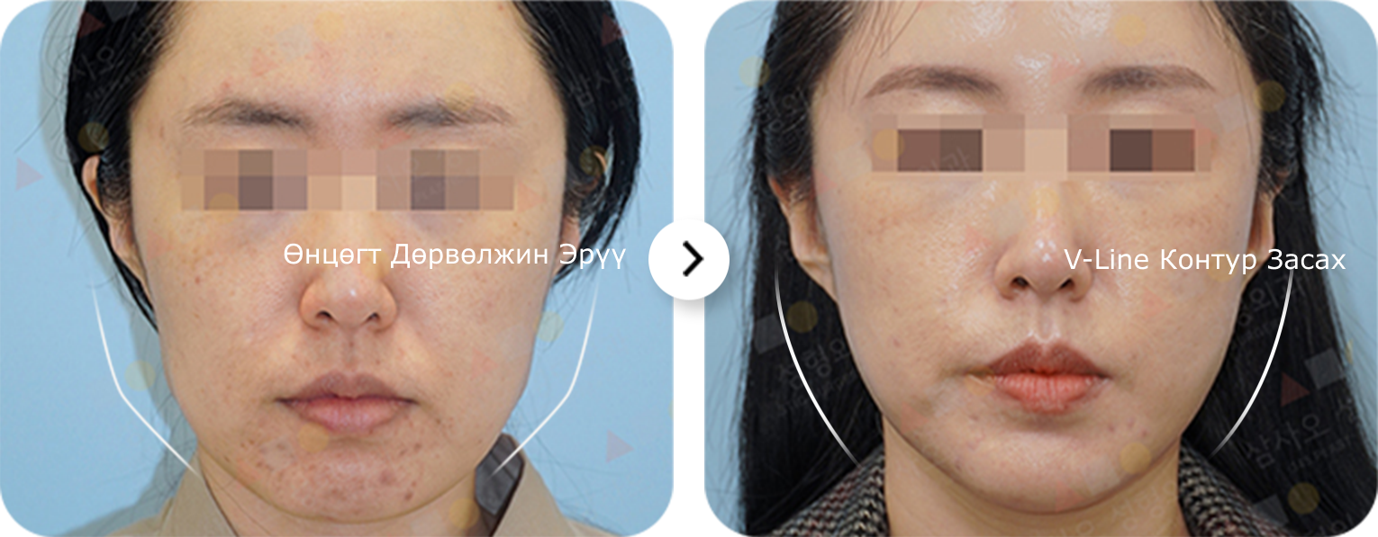 Эмэгтэй хүний нүүрний өнцөг хэлбэртэй эрүүг В-шугам контур заслын мэс ажилбараар өөрчилсөн хоёр харьцуулсан зураг.